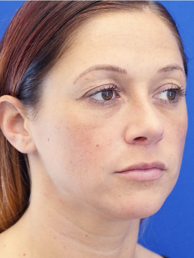 Dainty Nose — After