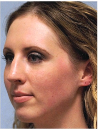 Crooked Nose & Cartilage Deformity1* — Before
