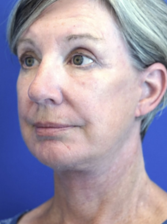 Deep Plane Face and Neck Lift — After