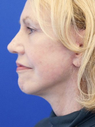 Deep Plane Lift and Superficial Laser — After