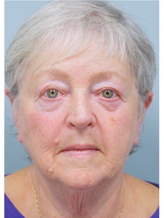 Aging Eyelid, Facelift, Necklift, Fractional CO2 Laser Resurfacing* — Before