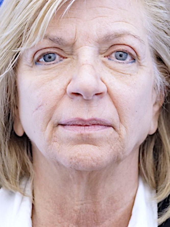 Jowls and Loose Neck Skin — Before