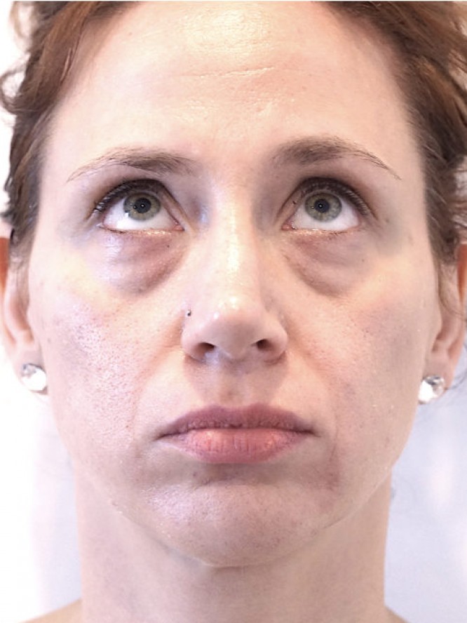 Under Eye Filling — Before