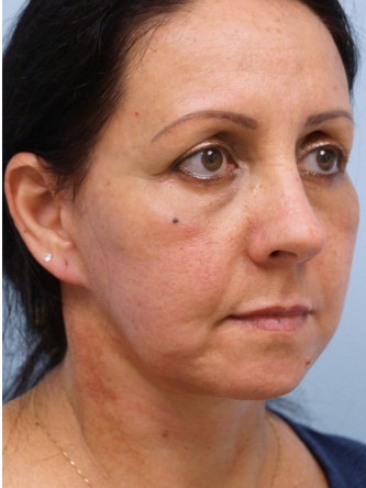 Aging Eyelid Rejuvenation, Facelift, Necklift 2* — After
