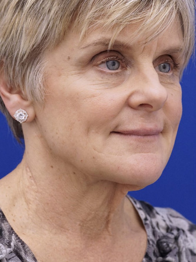 Lower Facelift Deep Plane — Before