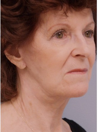 Facelift, Necklift, Platysmaplasty, ERB:YAG Laser Resurfacing* — After