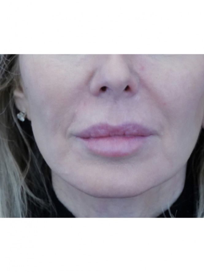 Voluminous Lips — Before
