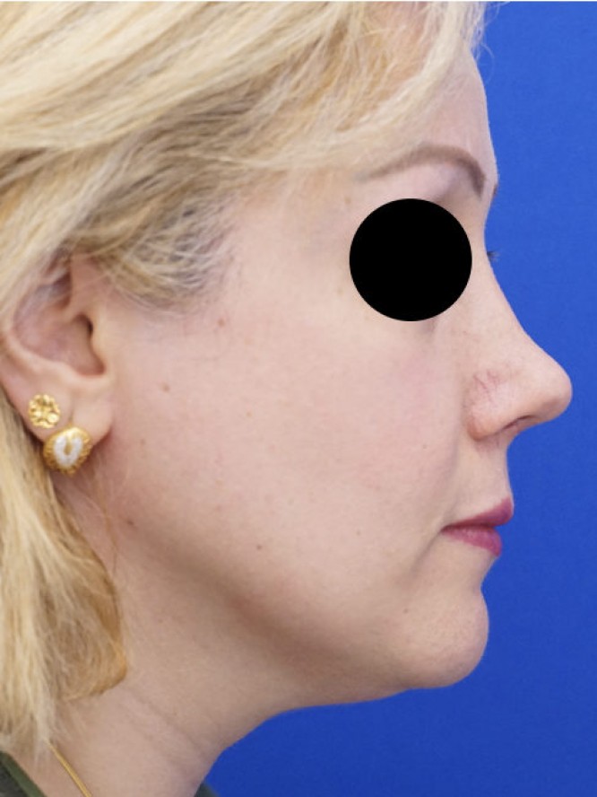 Over-Resected Nose — After