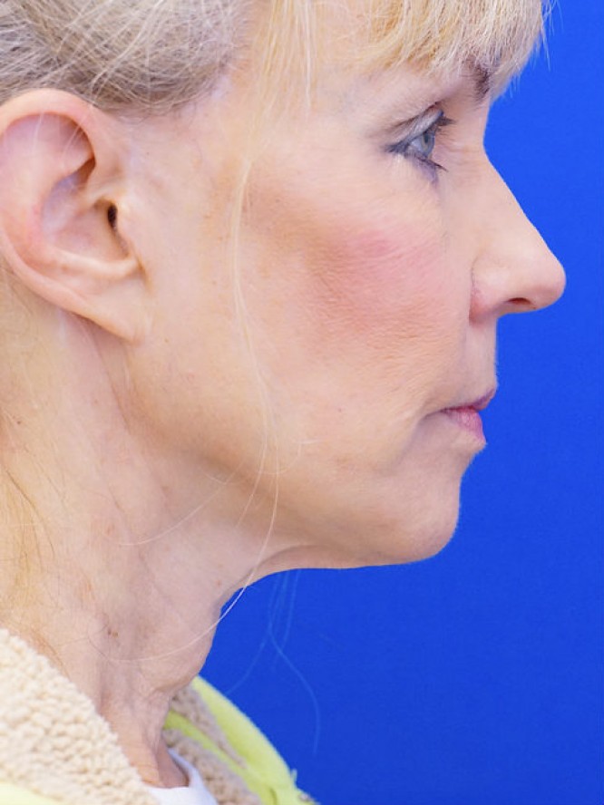 Neck Rejuvenation — Before