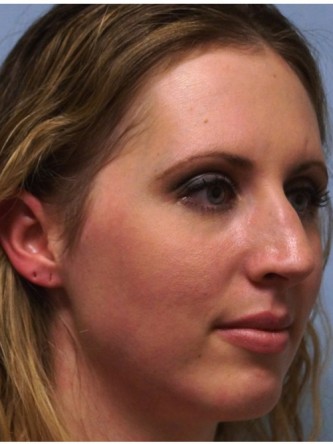 Crooked Nose & Cartilage Deformity1* — Before