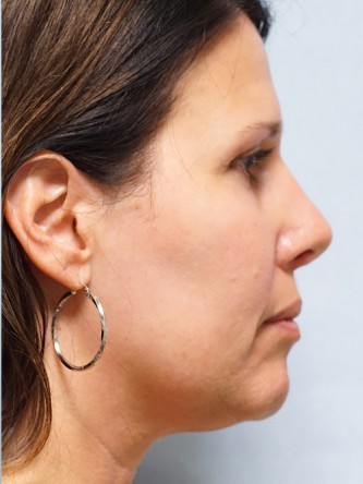 Tip Asymmetry and Hanging Columella* — After