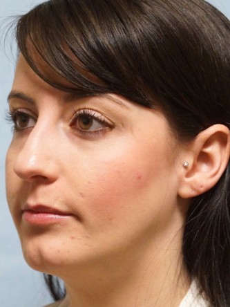 Repair of Nasal Septal Perforation* — Before