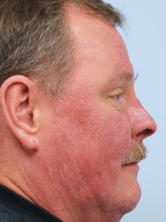 Rhinophyma* — After