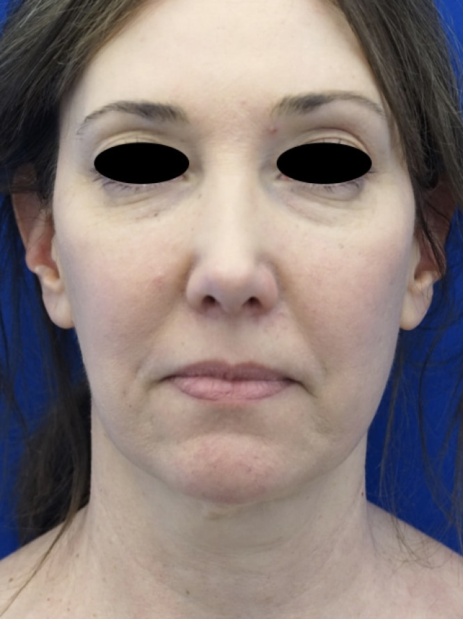 Secondary Deep Plane Lift with Scar Revision — Before