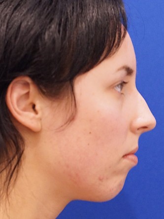 Chin Implant and Upper Lip Filler* — Before