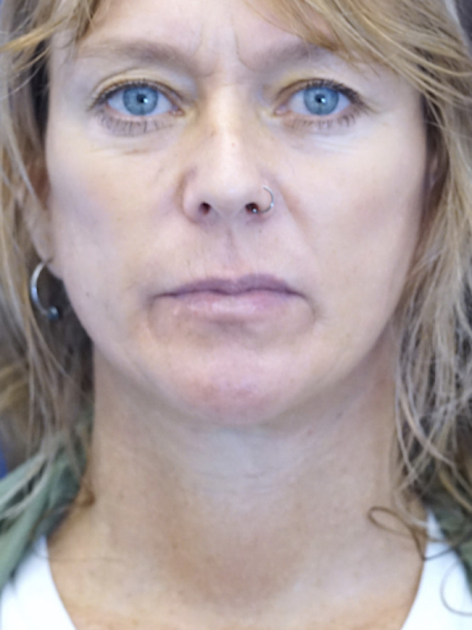 Fantastic Facial Profile — After