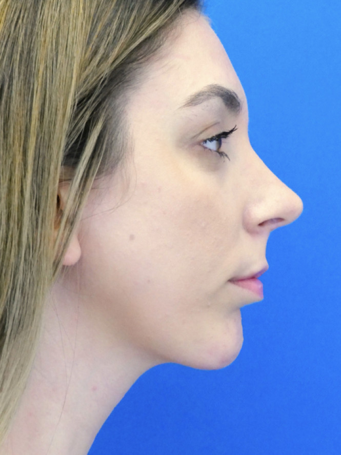 Facial Profile Balance — After