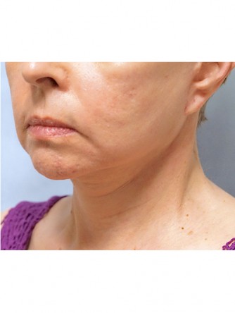 Neck Lift* — After