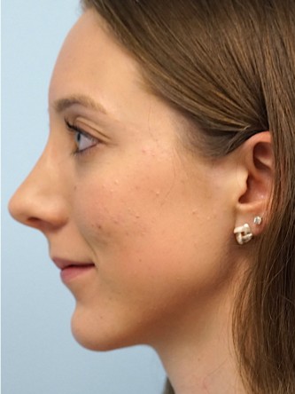 Nasal Hump Endonasal Rhinoplasty* — After