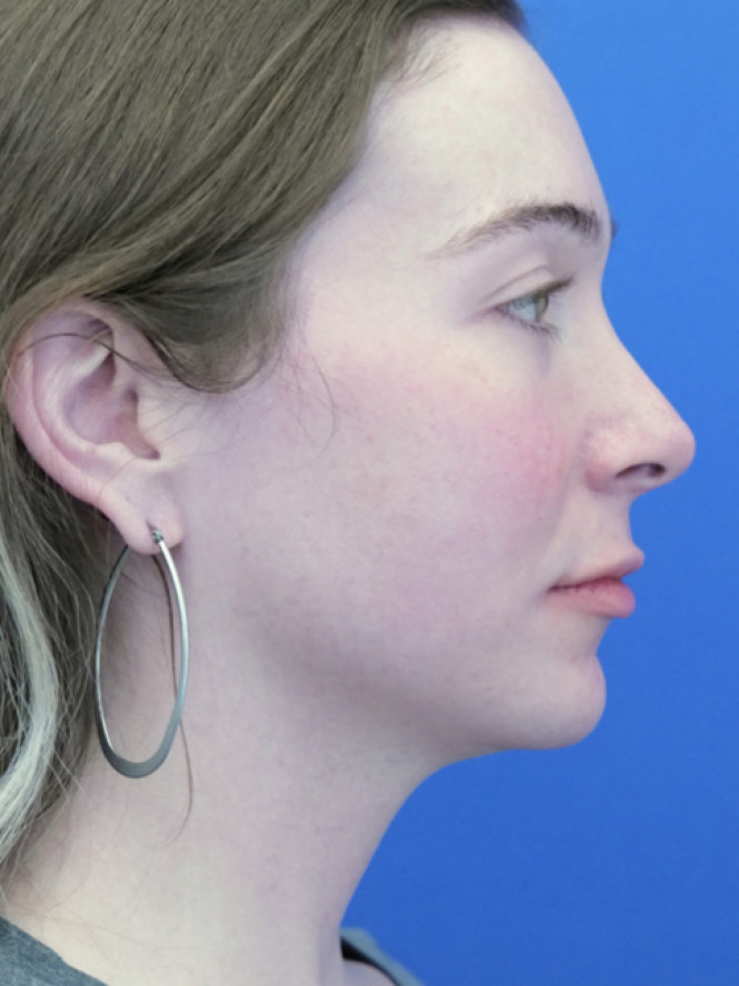 Soften Nasal Contour — After