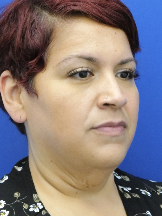 Necklift and Lower Facelift — Before