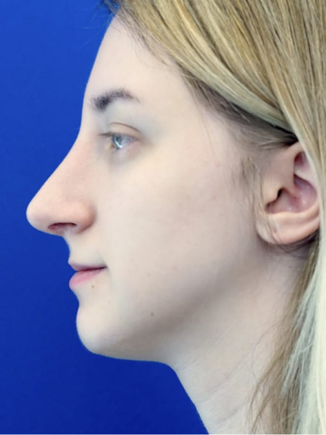 Dorsal Hump and Tension Tip — After