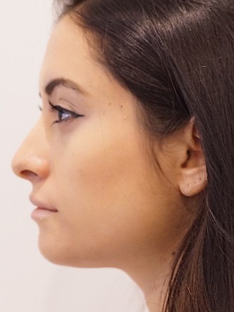 Restylane Silk to Volumize Lower Lip* — After