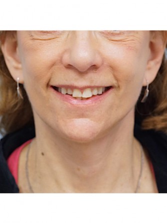 Full Face and Necklift, Upper and Lower Eyelid, Browlift* — After