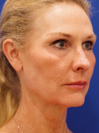 Mini Facelift* — Before