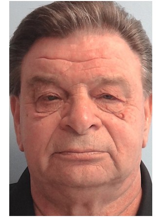 Upper Eyelid Droop and Excess Skin* — Before