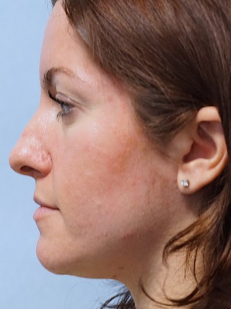 Boxy Tip Endonasal Rhinoplasty* — Before