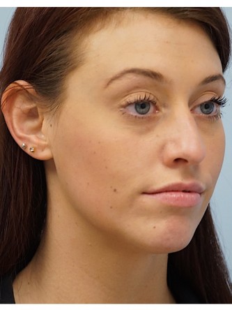 Cupid’s Bow Enhancement by Juvederm* — Before
