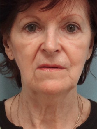 Facelift, Necklift, Platysmaplasty, ERB:YAG Laser Resurfacing* — Before