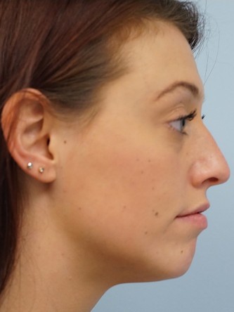 Cupid’s Bow Enhancement by Juvederm* — Before