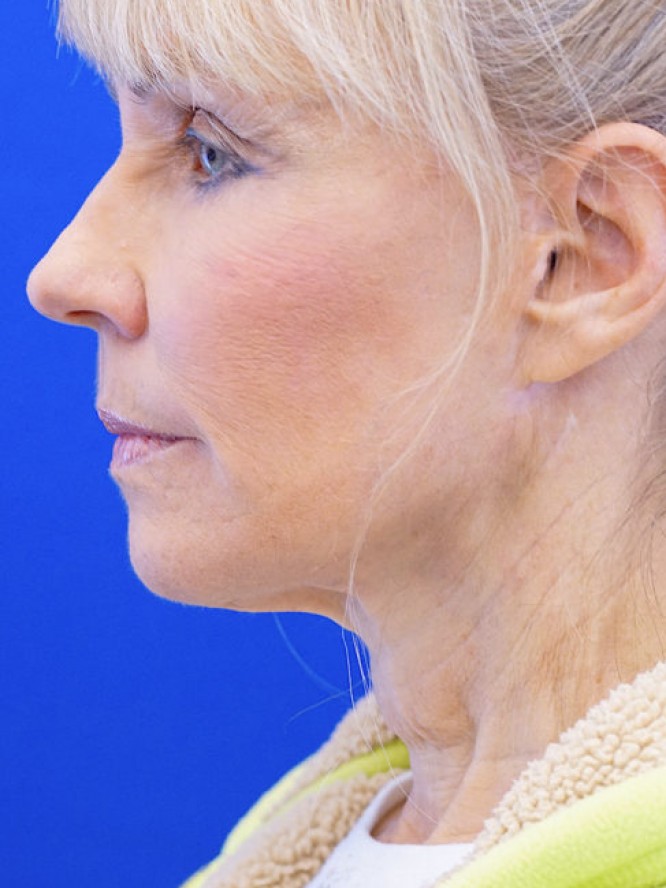 Neck Rejuvenation — Before