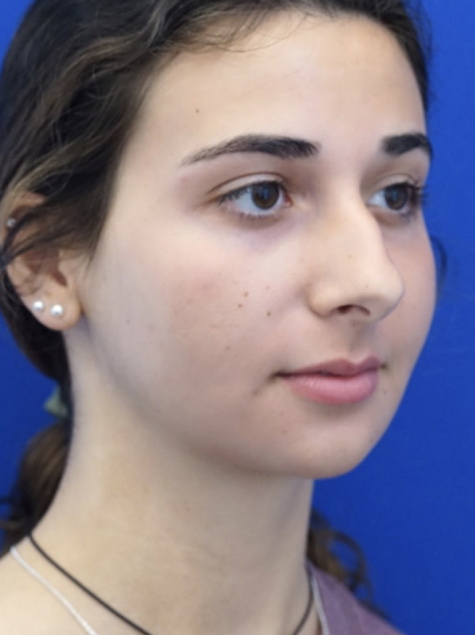 Classic Tension Nose — Before
