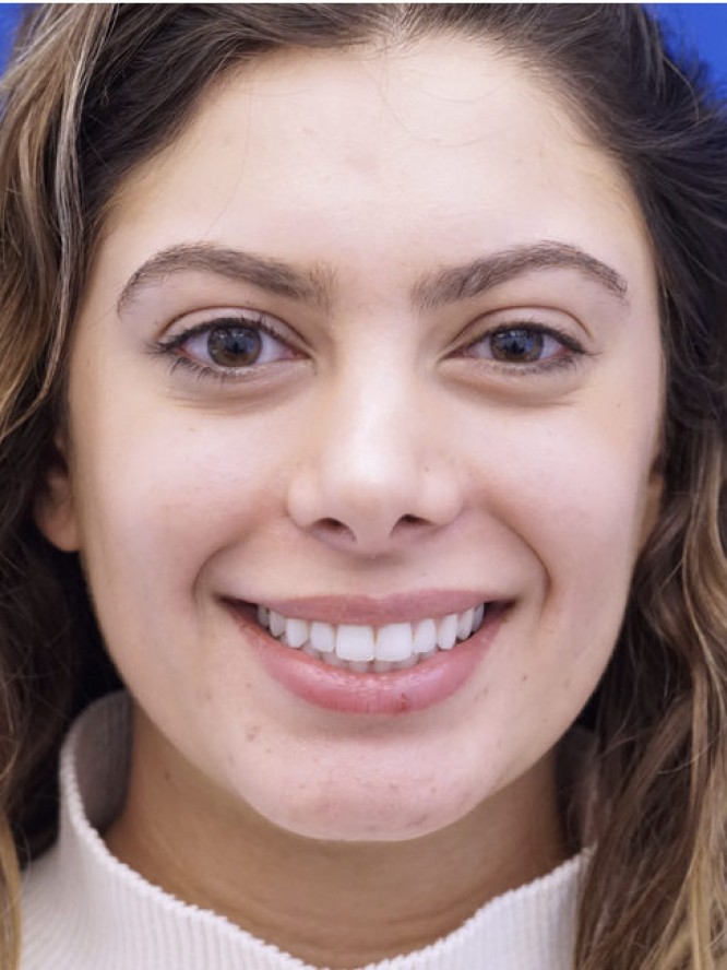 Hump Reduction and Chin Projection — After