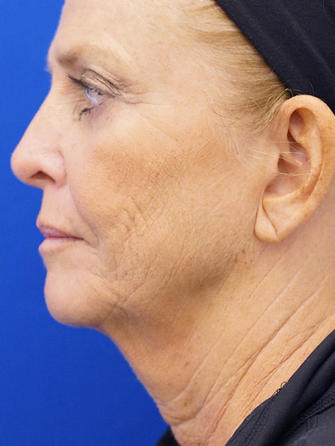 Deep Plane Lower Facelift — Before