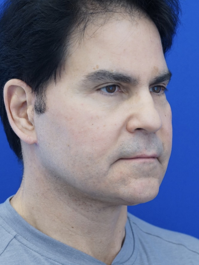Male Facelift — After