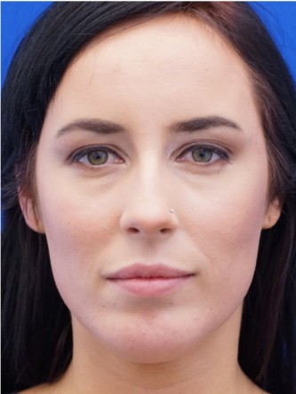 Chin Implant and Upper Lip Filler* — After