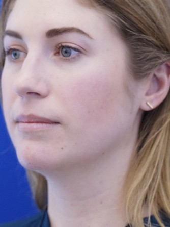 Chin LipoSculpture* — Before
