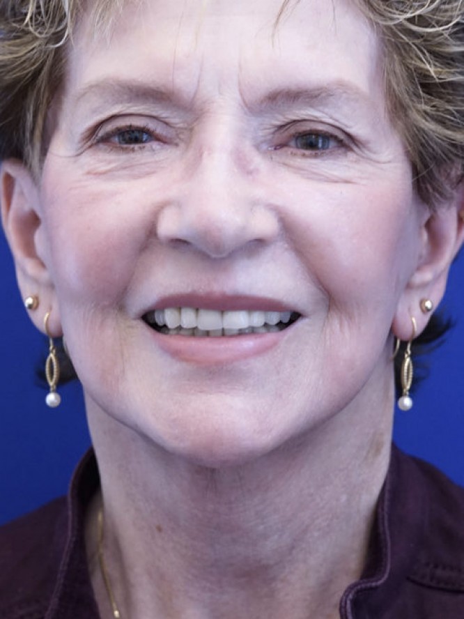 Deep Plane Facial Rejuvenation — After