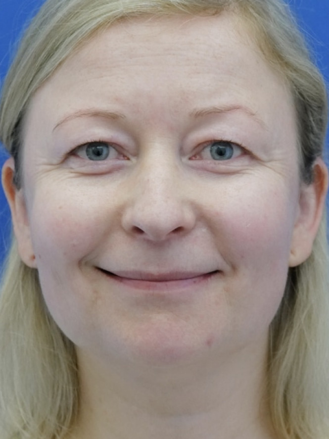 Eyelid Lift and Brow Fat Suspension — Before