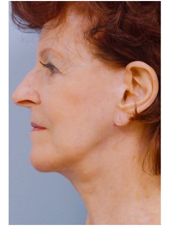 Facelift, Necklift, Platysmaplasty, ERB:YAG Laser Resurfacing* — After