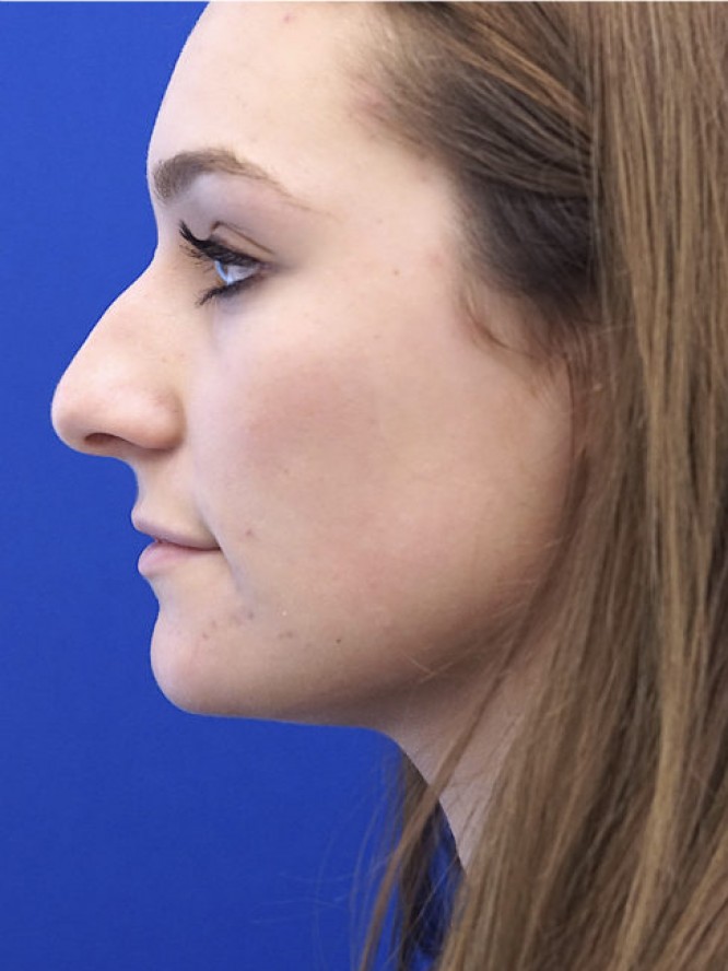 Endonasal Profile — Before