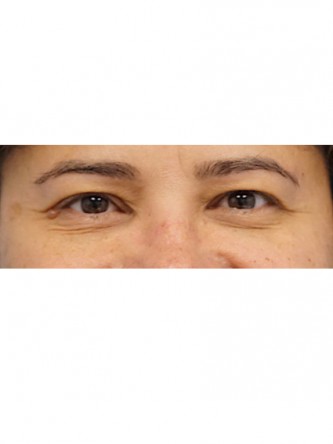 Right Ptosis Repair* — After