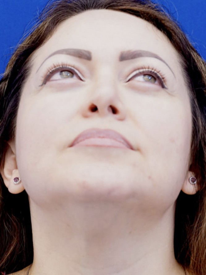Nasal Tip Asymmetry — Before