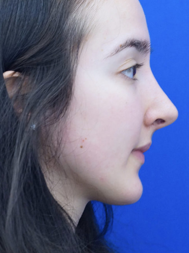 Endonasal Finesse Rhinoplasty — After