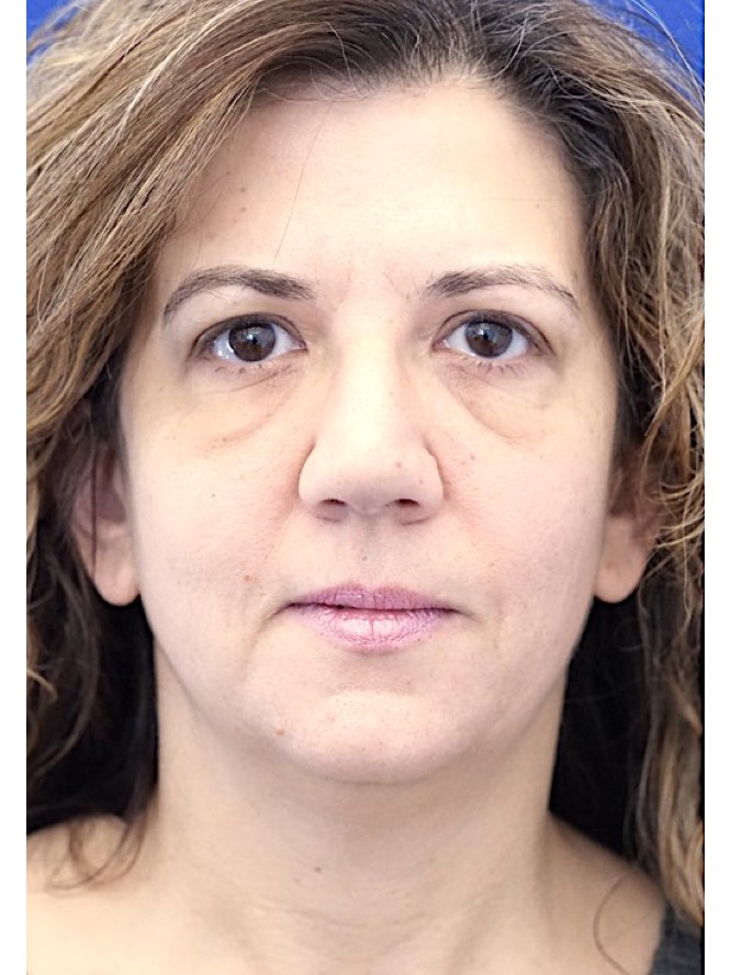 Deep Plane Face Lifting — Before