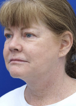 Surgical Neck Lift — After